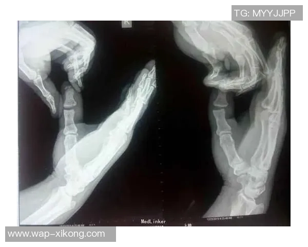 麦凯恩成功接受拇指韧带修复手术预计缺阵至少一个月